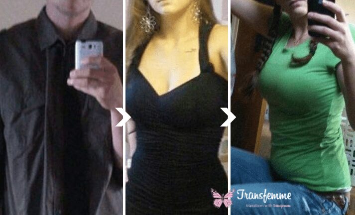 Before and after breast enlargement by Transfemme