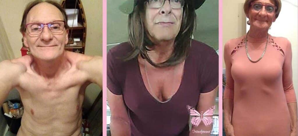 transfemme breast enlargement after and before