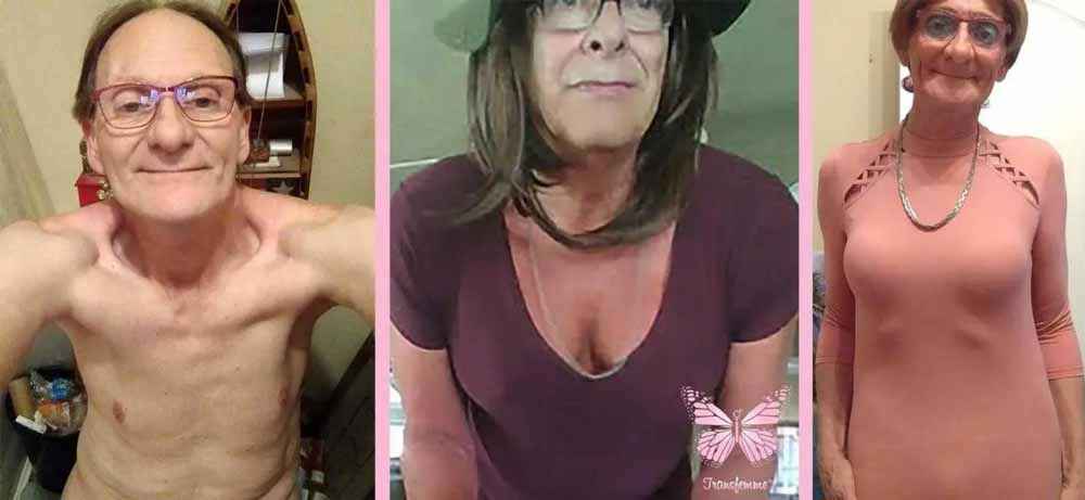 Transfemme customer for MTF breast growth